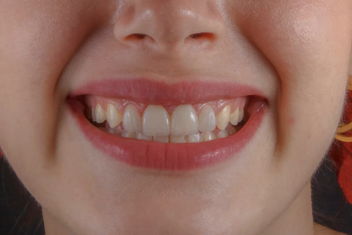 Traveling with Children for Dental Treatment in Turkey: What to Expect