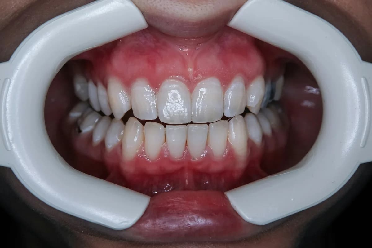 Sinus Lift: Step-by-Step Guide for Implant Prep in Antalya